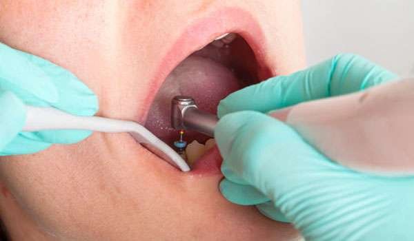 Electric Handpiece Image 2