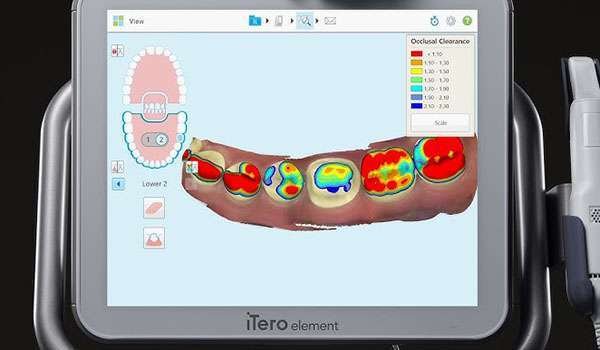 Itero 3D Intraoral Scanner Image 1
