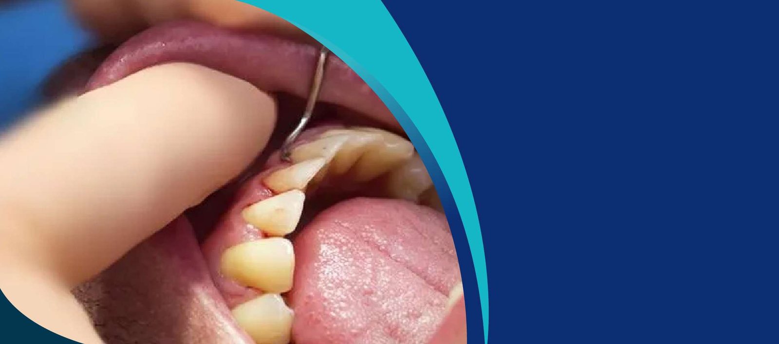 Piezotomes Background